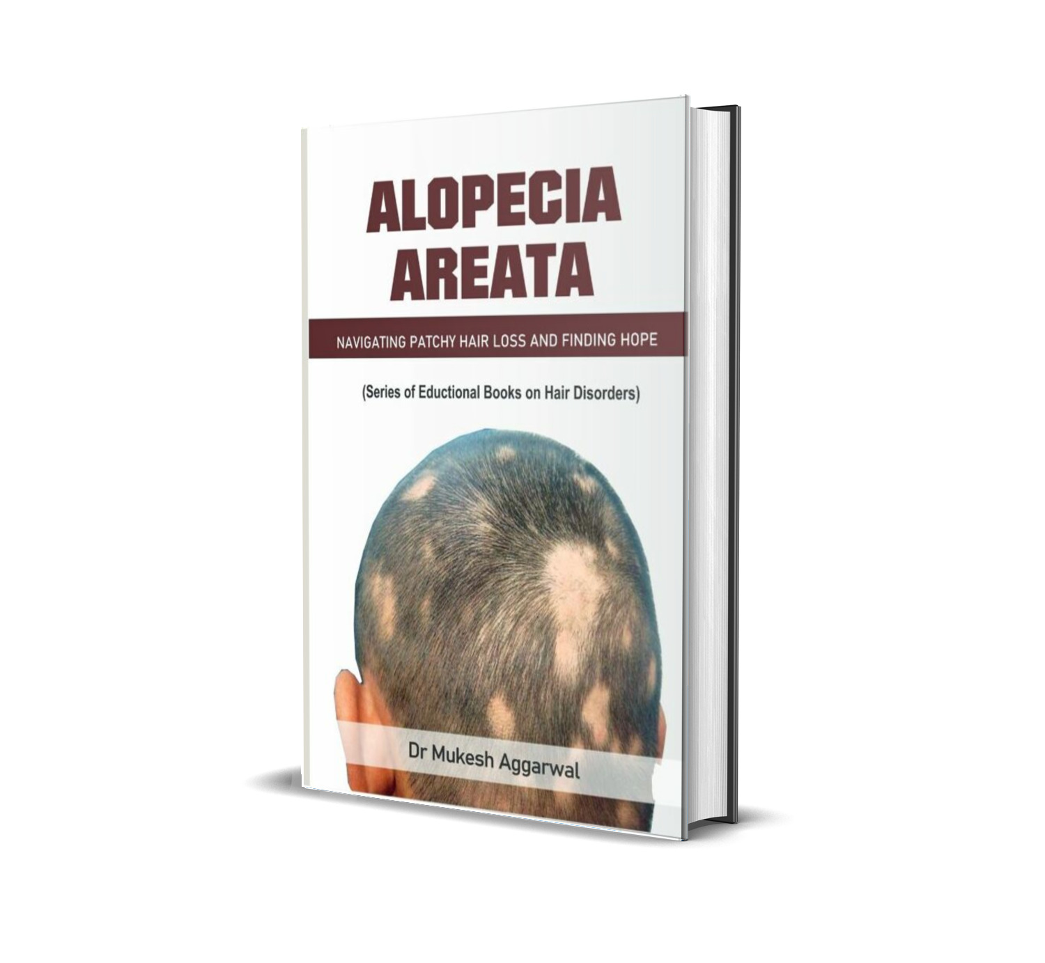 ALOPECIA AREATA