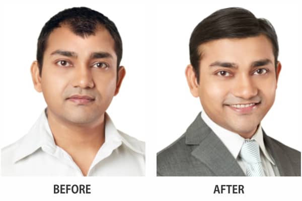 Best Hair Fixing Service In Delhi -