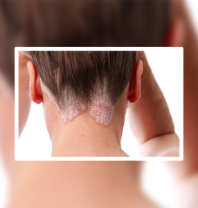 TREATMENT FOR PSORIASIS